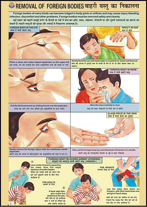 Removal of foreign bodies from eye, ear, nose