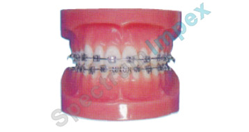Fixed Orthodontic Model (Normal)