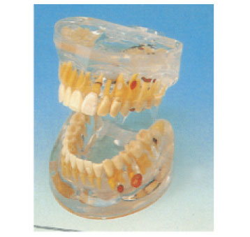 Transparent Dental Pathology Model